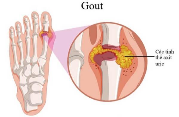 Người bệnh gout không nên ăn khoai môn